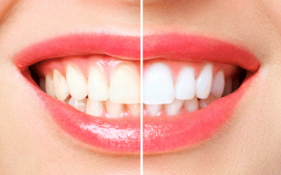 How to Get a Brighter Smile with Teeth Whitening
